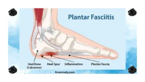 bone-spur-or-plantar-fasciitis