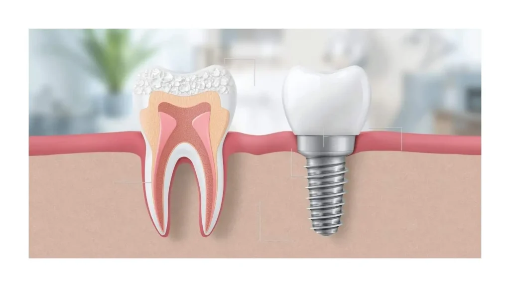 crown-or-implant