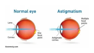 stigmatism-or-astigmatism